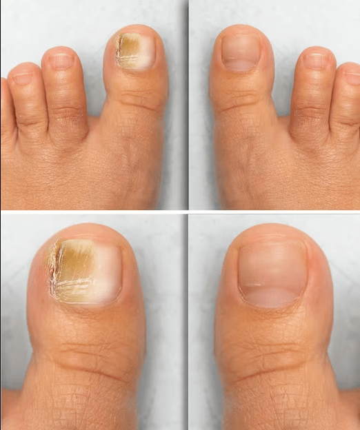 Fungus on the feet - before and after treatment with cream Fungent