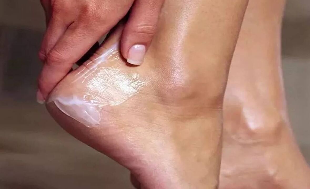 How to treat fungus with fantastic cream