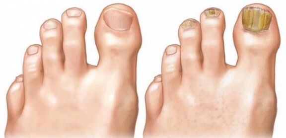 Normal and infected nails