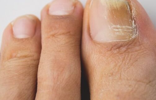 Fungus nail