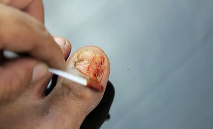 Treatment of lesion with fungus