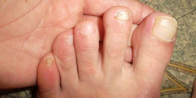 Nail update after injury
