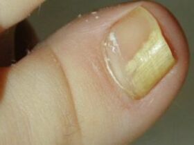 Sick nail