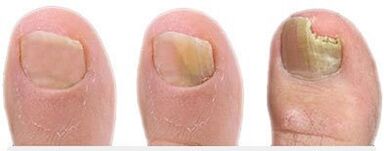 Phases of the fungus development on the nails