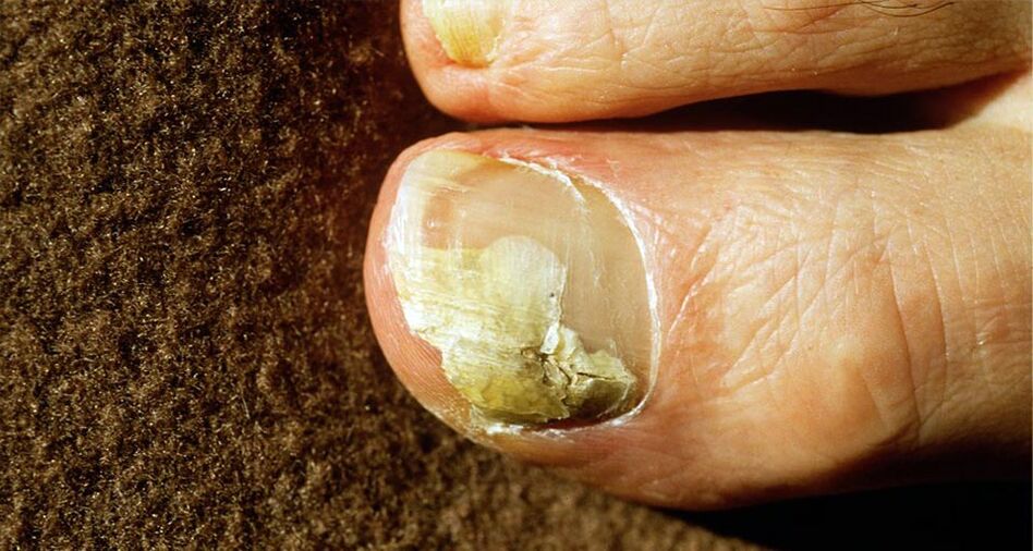 Fungus feet