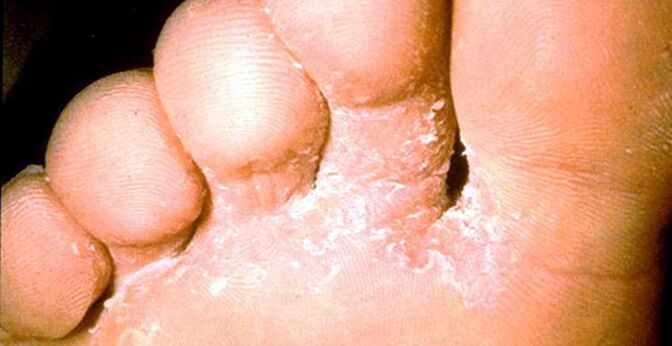 Lesia of the leather fungus between toes