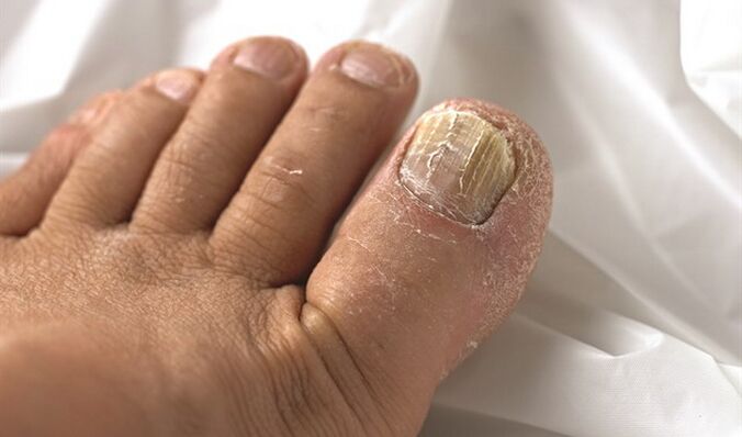 Spreading mycous lesions on the nail plate