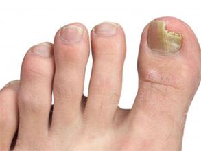 Yellow spots on nail signs of feet feet