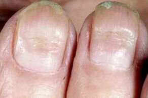 nail fungus symptoms