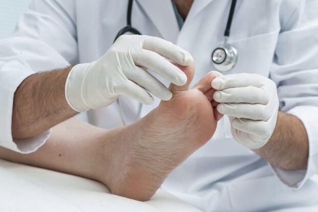 doctor's diagnosis of foot fungus