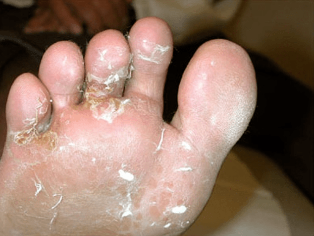 toe fungus development