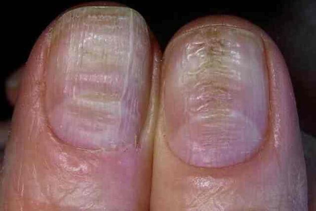 fungal infection of the nail plate
