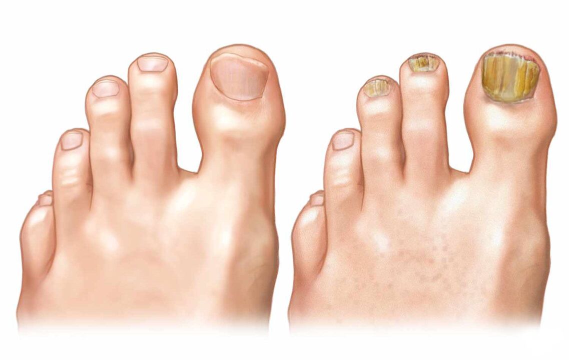 healthy nails and foot fungus