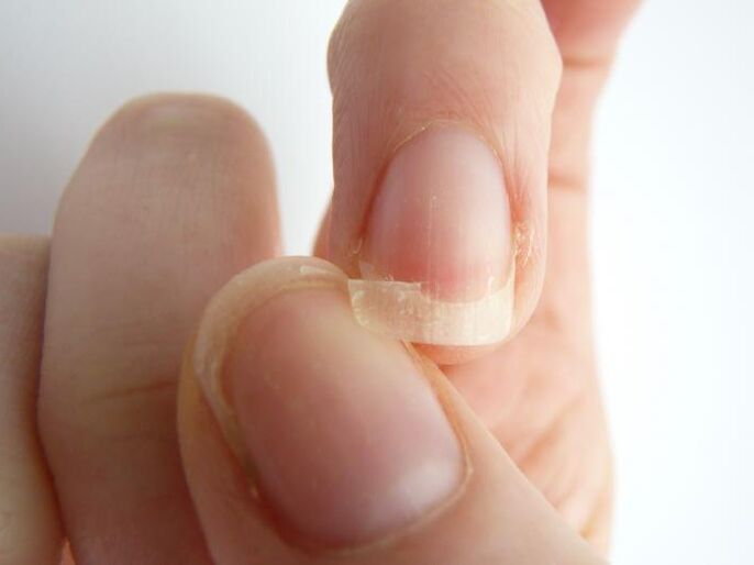 nail separation due to fungus