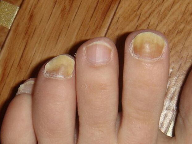 toenail fungus symptoms