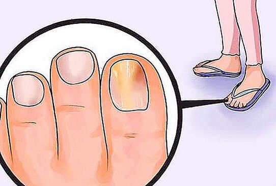 toenail fungus