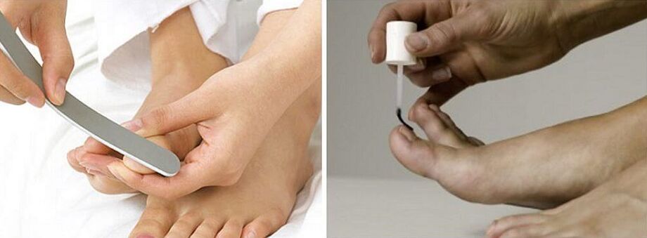 treatment of toenail fungus with varnish